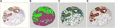 Reliability of CD44, CD24, and ALDH1A1 immunohistochemical staining: Pathologist assessment compared to quantitative image analysis